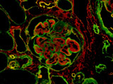 Collagenofibrotic Glomerulonephropathy in a dog (double immunofluorescent antibody test for Type 3 and Type 4 collagen)